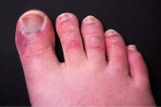 Study suggests immune system response behind ‘Covid toe’