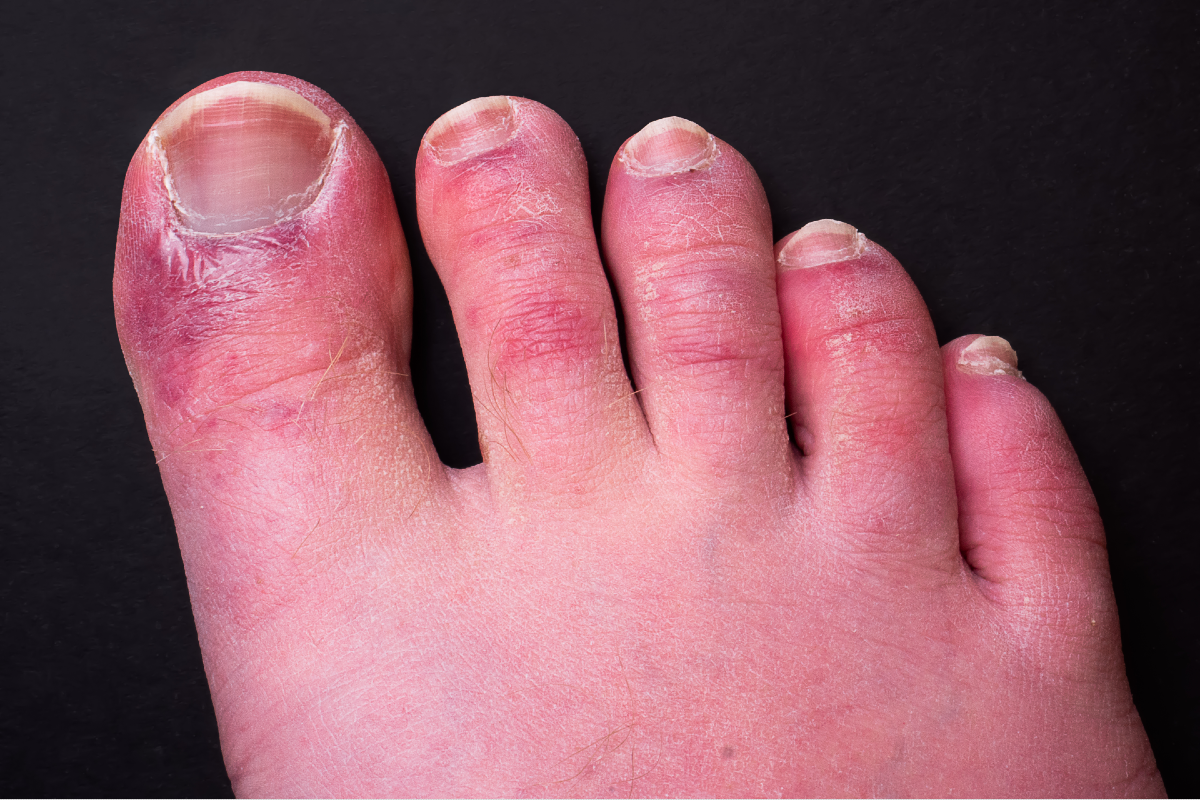 Study Suggests Immune System Response Behind Covid Toe Pulse Today