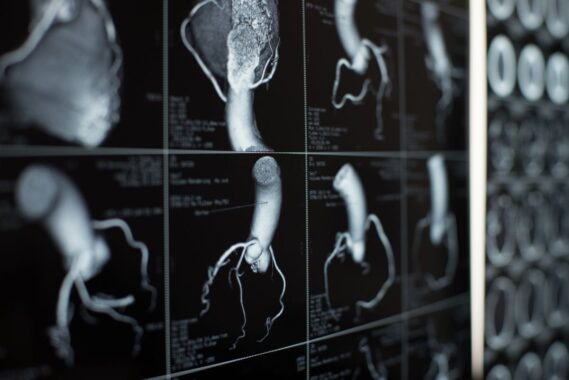 Clinical conundrum: An incidental finding of calcified coronary arteries on lung cancer screening