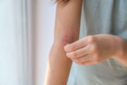 Eczema: Myths and Facts